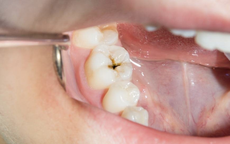 Aligner tray illustration